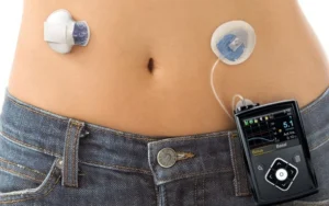 Abdomen con catéter de bomba de insulina y dispositivo sujeto al pantalón para controlar la diabetes